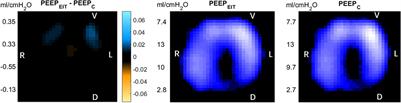 Comparison of Global and Regional Compliance-Guided Positive End-Expiratory Pressure Titration on Regional Lung Ventilation in Moderate-to-Severe Pediatric Acute Respiratory Distress Syndrome